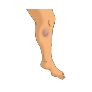 bruise