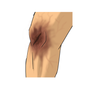 infection