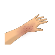 rash